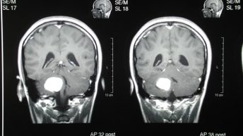 nanoparticulas tumores cerebrales
