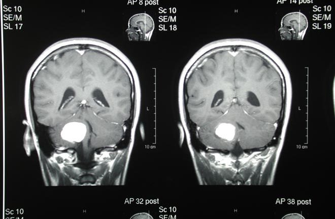 nanoparticulas tumores cerebrales