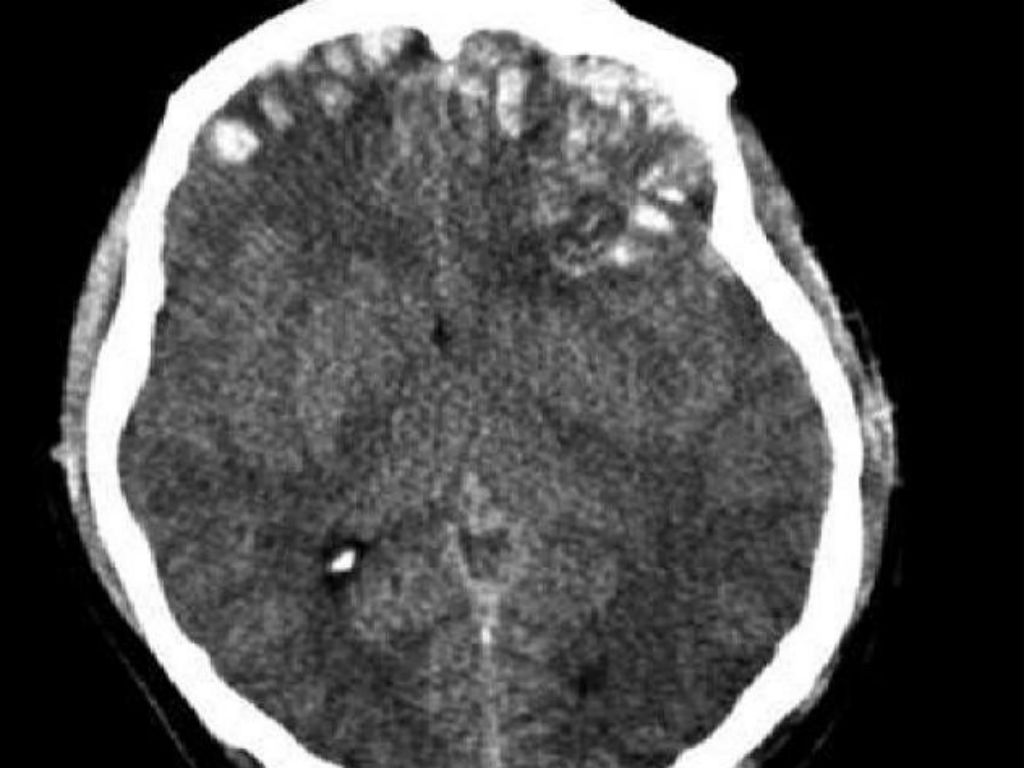 Este proyecto podría lograr revivir cerebros con daños cerebrales irreversibles. 