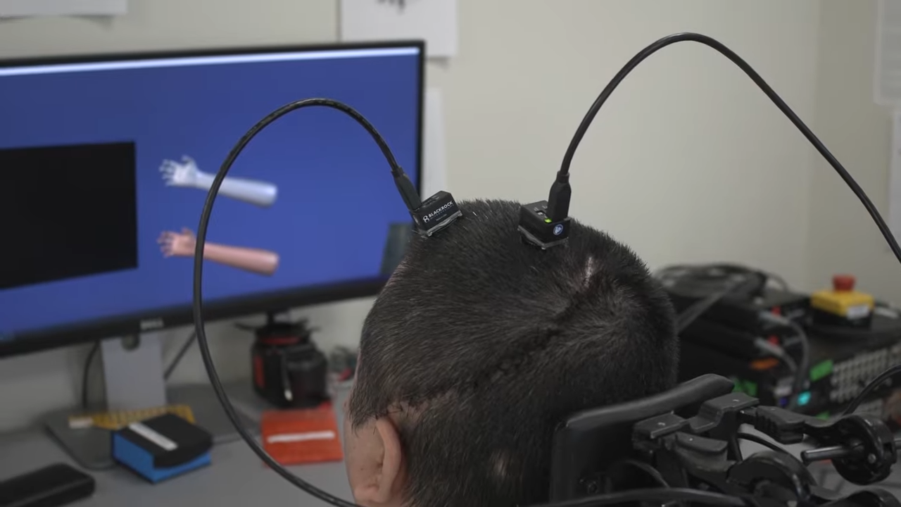Este chip cerebral con IA puede devolver la movilidad y sensibilidad a pacientes con parálisis