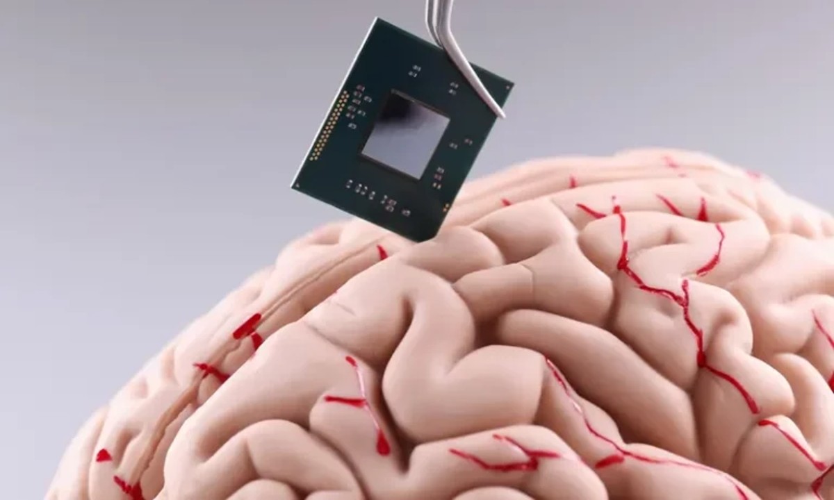 Segundo paciente con chip Neuralink; ¿qué tan ‘sobrenatural’ es este implante cerebral?